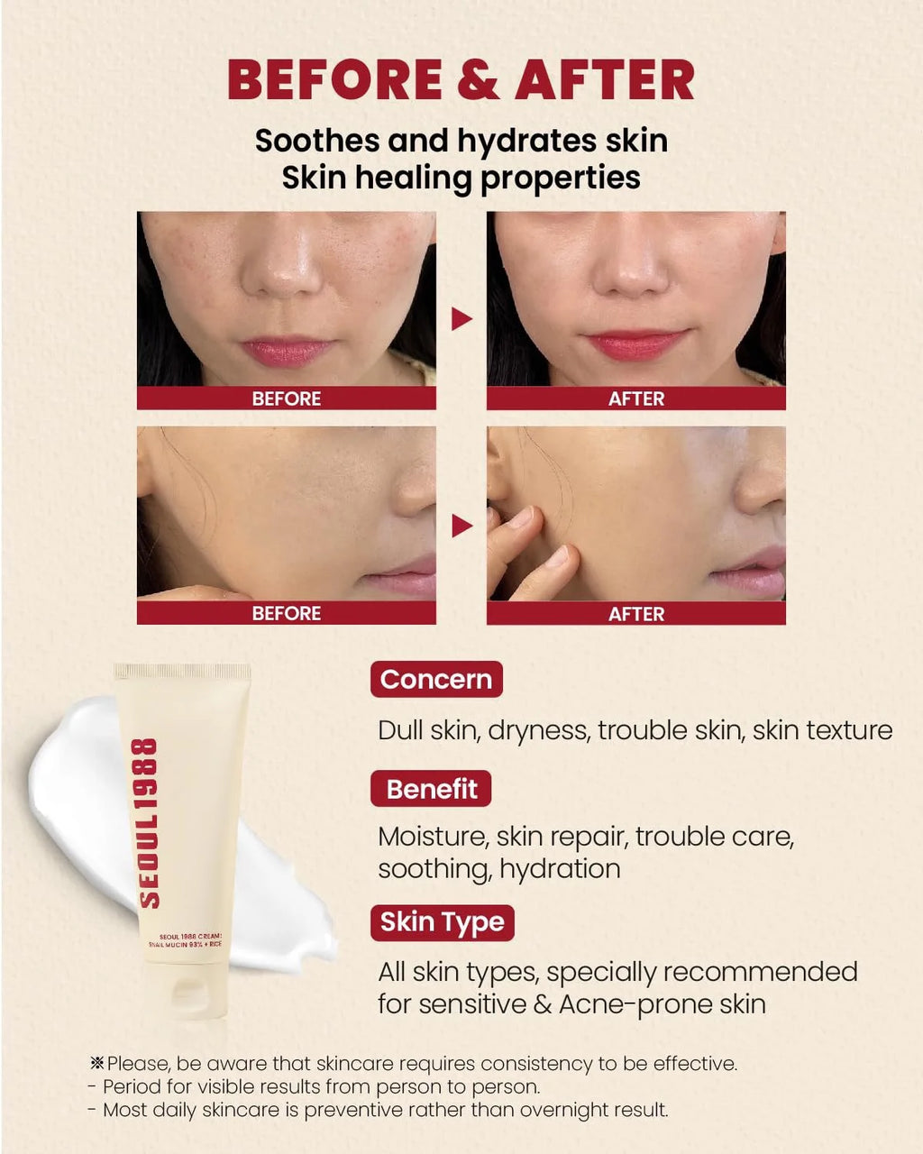 SEOUL 1988 Hydrating Repair Snail Cream – 93% Snail Mucin + Rice Ferment (100ml / 3.38 fl.oz.)