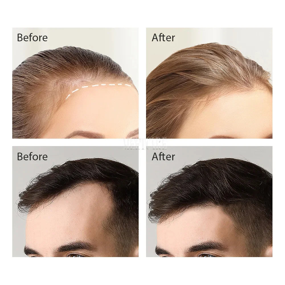 Bio Needle 120 Adjustable Microneedling Derma Stamp – Professional Hair Regrowth & Anti-Aging Skin Renewal System