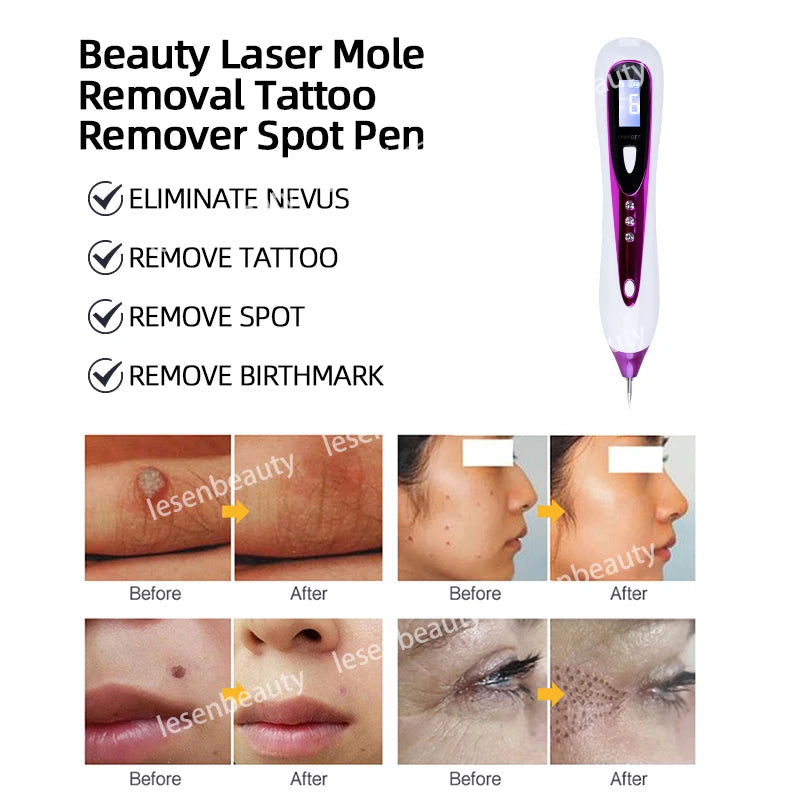 Professional Plasma Pen – 2-in-1 Laser Mole, Tattoo & Dark Spot Remover