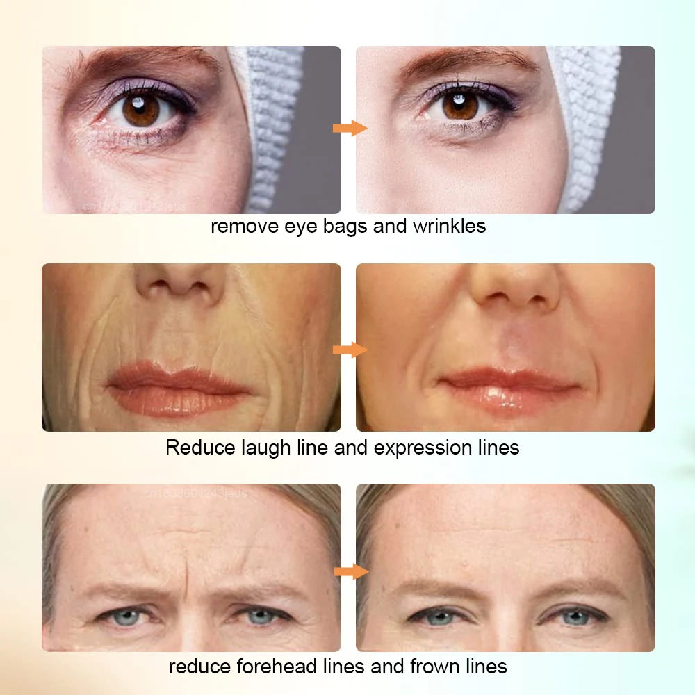 5-in-1 Professional Anti-Aging Facial Rejuvenation & Skin Tightening Device